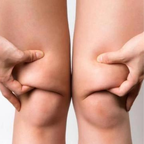 Knee liposuction Tel-Aviv