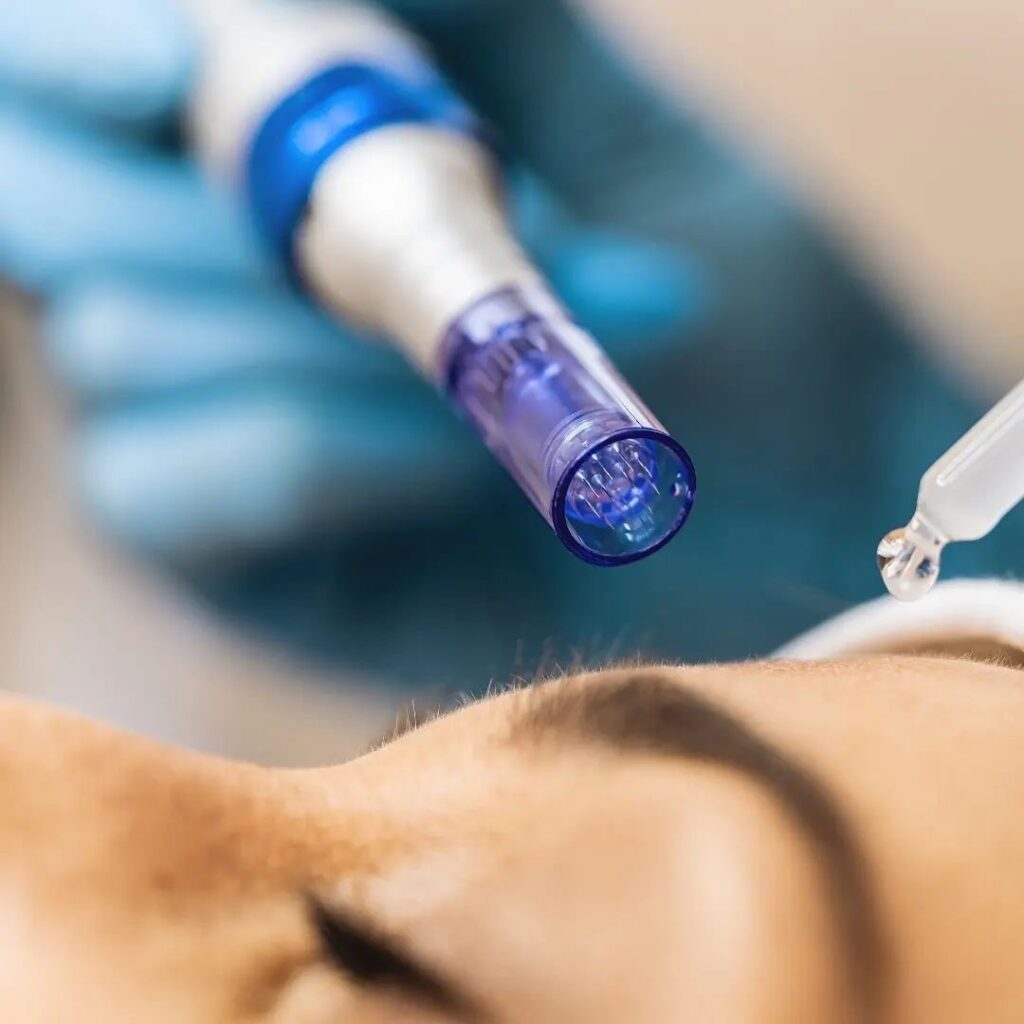 Dermapen - Exosomes myclinic Tel-Aviv
