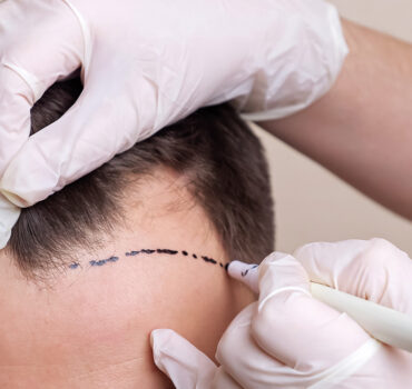 Hair transplant - myclinic Tel-Aviv