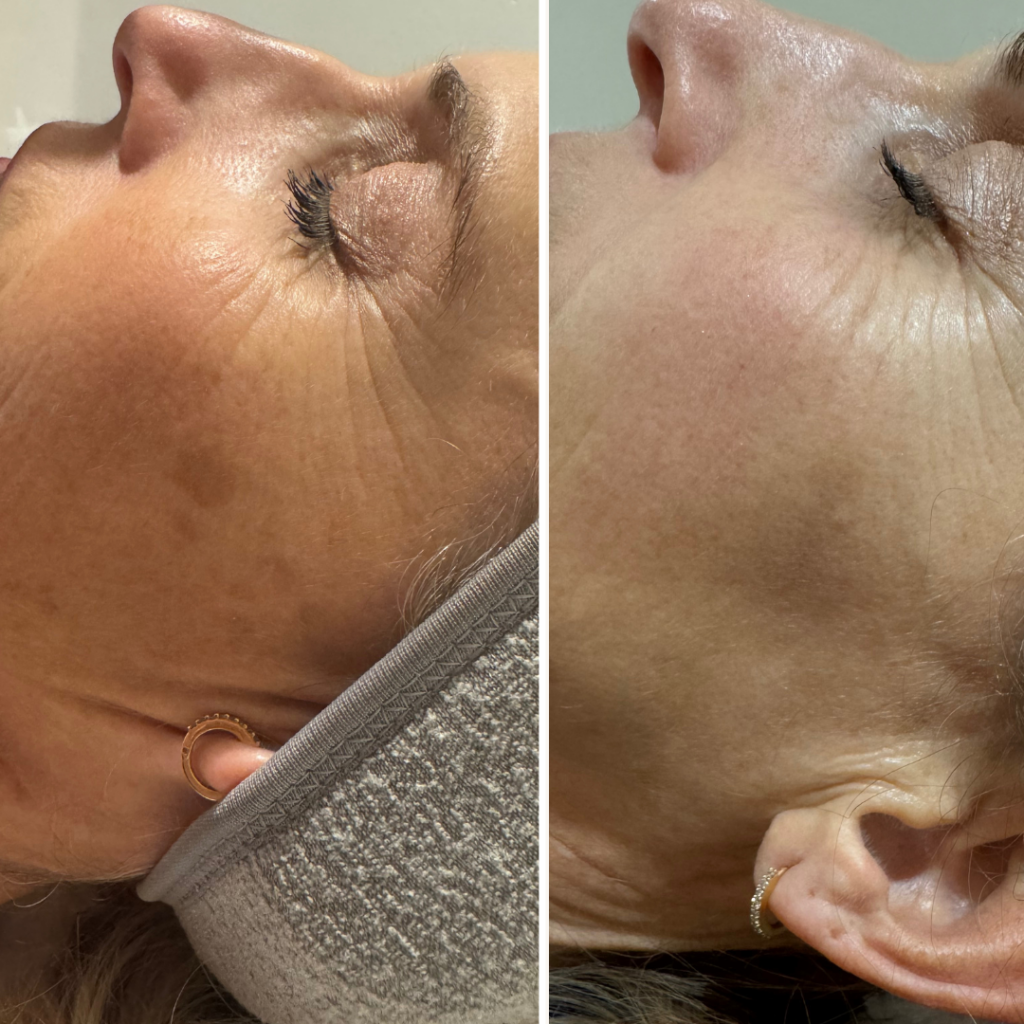 Lumecca IPL - לייזר דרמטולוגי - myclinic תל אביב