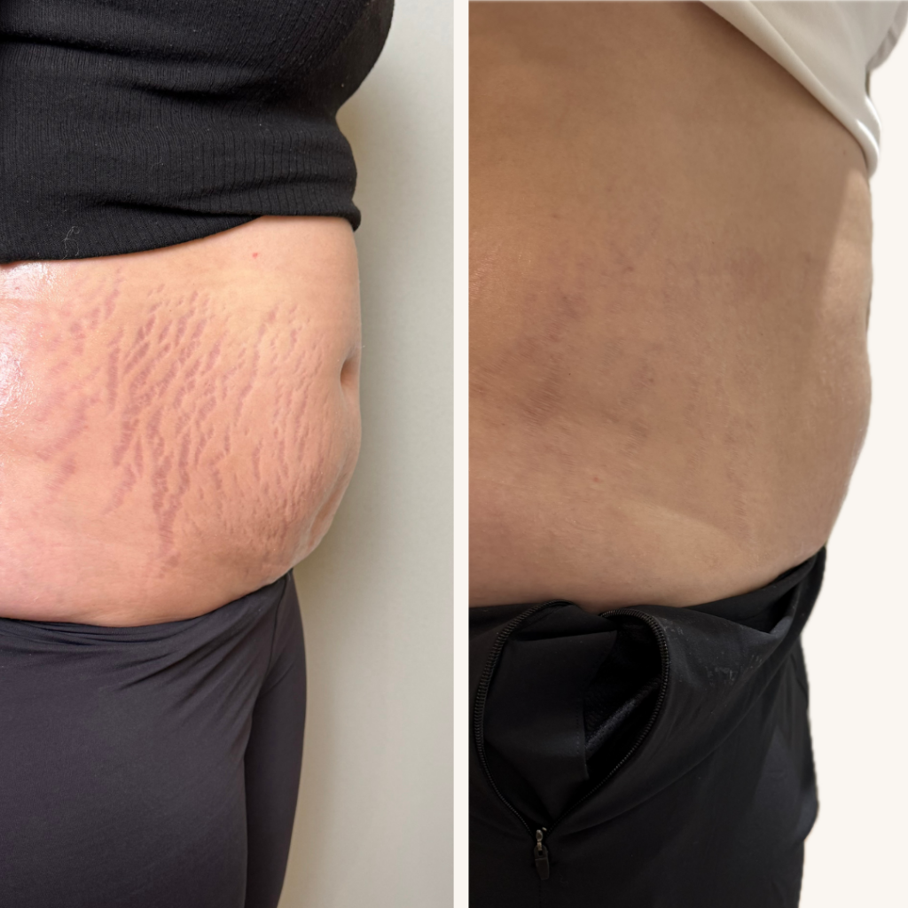 Morpheus 8 - myclinic Tel-Aviv