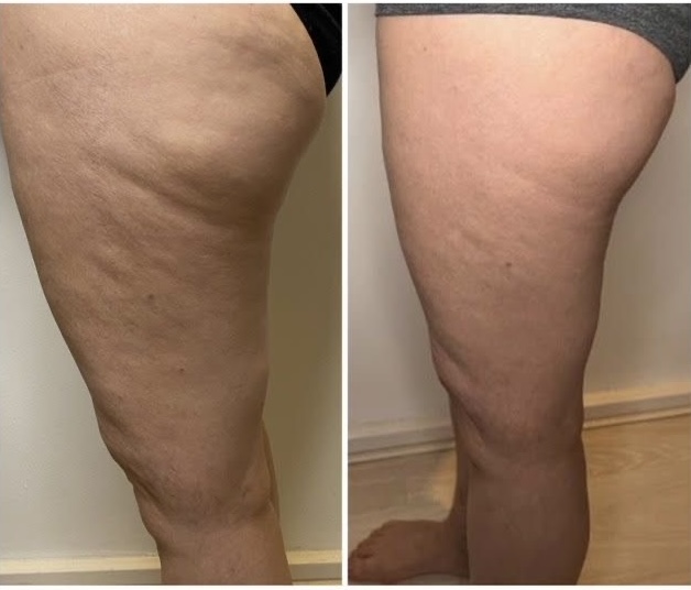 LPG Slimming, Anti-Aging & Anti-Cellulite Skin Treatment - myclinic Tel-Aviv