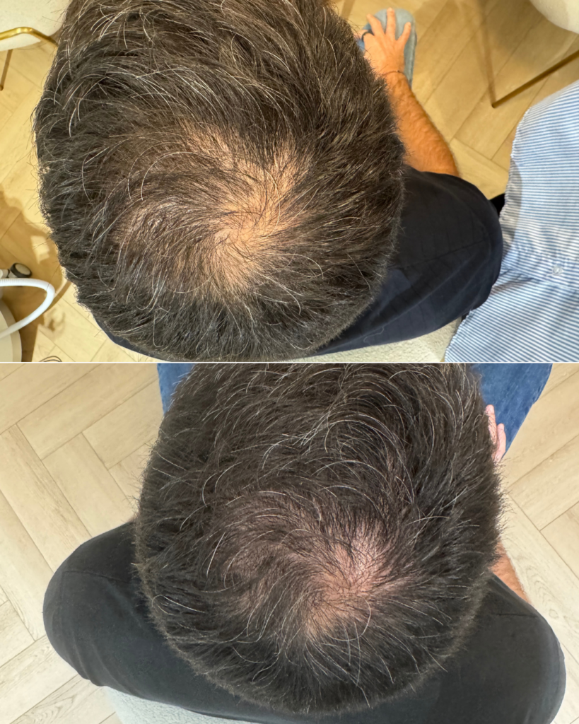 PRF Hair - myclinic Tel-Aviv