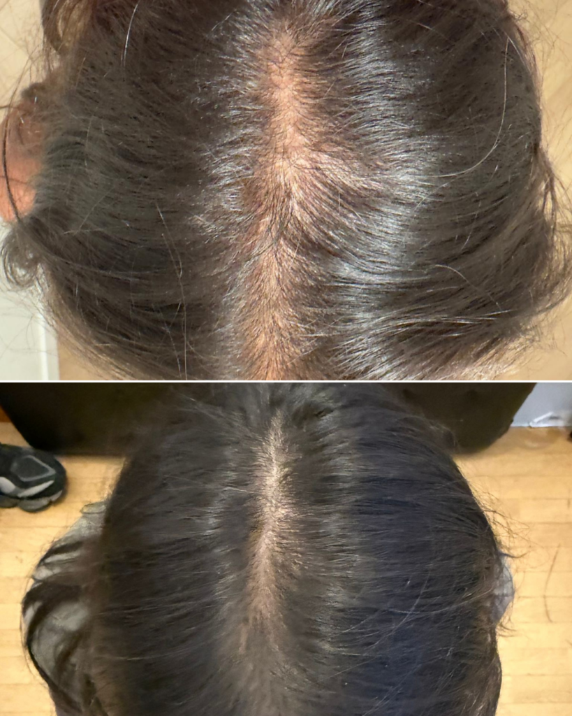 PRF Hair - myclinic Tel-Aviv