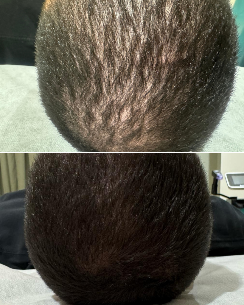 PRF Hair - myclinic Tel-Aviv