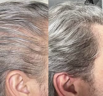 Dermapen + Exosomes Cheveux - myclinic Tel-Aviv