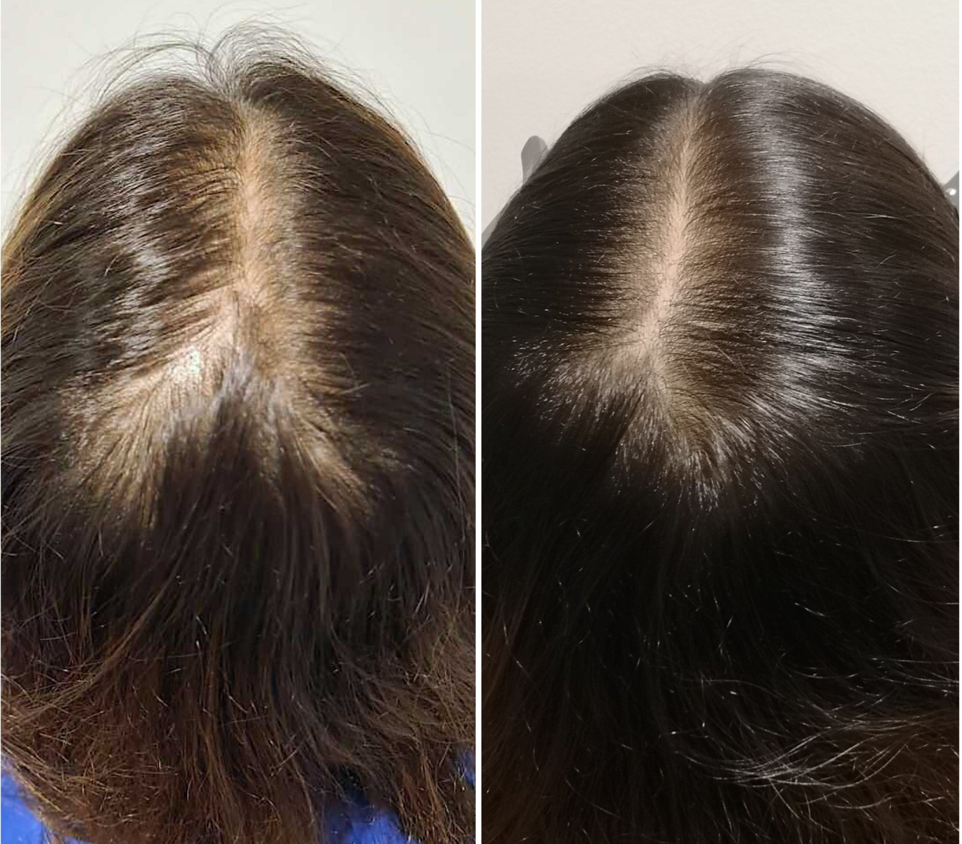 Dermapen + Exosomes Cheveux - myclinic Tel-Aviv