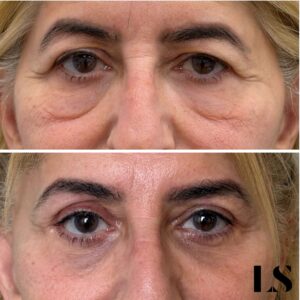 Before / After - Upper &amp; Lower Blepharoplasty - by Dr Samuel Levy - myclinic Tel-Aviv