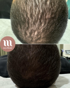 לפני / אחרי - טיפול PRF לשיער - myclinic - תל אביב