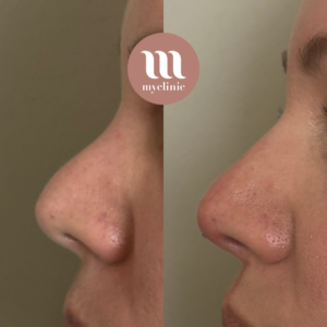 Before / After - Medical Rhinoplasty - myclinic - Tel-Aviv