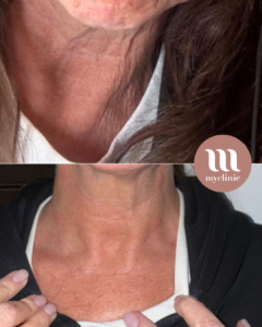 Before / After - Radiesse & Morpheus8 Treatments - myclinic - Tel-Aviv