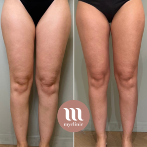 Before / After - LPG & Mesotherapy - myclinic - Tel-Aviv