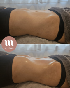 Before / After - Lymphatic Drainage Renata Franca - myclinic - Tel-Aviv