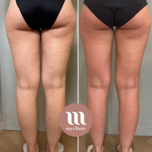 Before / After - LPG & Mesotherapy - myclinic - Tel-Aviv