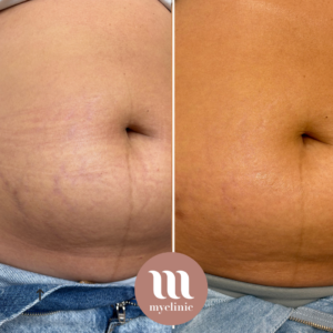 Before / After - Morpheus8 Body - myclinic - Tel-Aviv