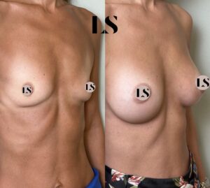 Before / After - Breast Augmentation - by Dr. Samuel Levy - myclinic Tel-Aviv