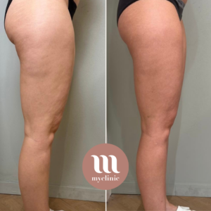 Before / After - LPG & Mesotherapy - myclinic - Tel-Aviv