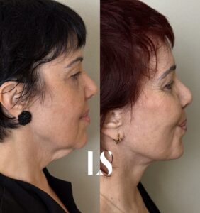 Before / After - Face &amp; Neck Lift - by Dr. Samuel Levy - myclinic Tel-Aviv