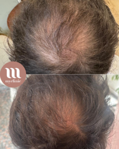 לפני / אחרי - טיפול PRF לשיער - myclinic - תל אביב