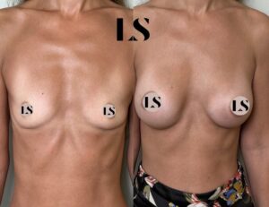 Before / After - Breast Augmentation - by Dr. Samuel Levy - myclinic Tel-Aviv