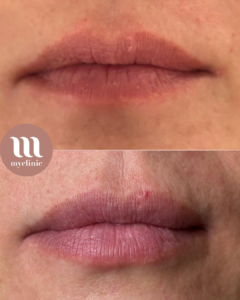 Before / After – Hyaluronic Acid Lip Enhancement - myclinic - Tel-Aviv