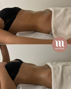Before / After - Lymphatic Drainage Renata Franca - myclinic - Tel-Aviv