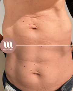 לפני / אחרי - Morpheus8 Body - myclinic - תל אביב