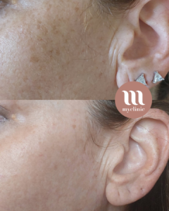 לפני / אחרי - IPL Lumecca – כתמי שמש - myclinic - תל אביב