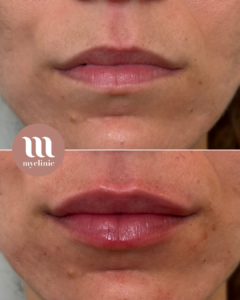 Before / After – Hyaluronic Acid Lip Enhancement - myclinic - Tel-Aviv