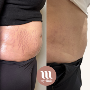 לפני / אחרי - Morpheus8 Body - myclinic - תל אביב