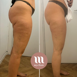 Before / After - LPG - myclinic - Tel-Aviv