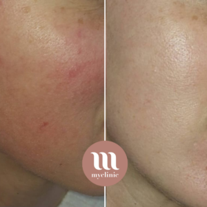 לפני / אחרי - IPL Lumecca – רוזציאה - myclinic - תל אביב