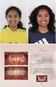 Before / After – Orthodontic Treatment - Dr Ruben Abou - myclinic Tel-Aviv