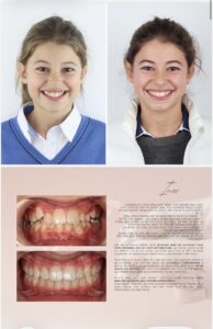 Before / After – Orthodontic Treatment - Dr Ruben Abou - myclinic Tel-Aviv