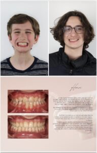 Before / After – Orthodontic Treatment - Dr Ruben Abou - myclinic Tel-Aviv