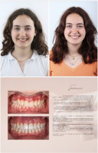 Before / After – Orthodontic Treatment - Dr Ruben Abou - myclinic Tel-Aviv