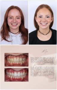 Before / After – Orthodontic Treatment - Dr Ruben Abou - myclinic Tel-Aviv