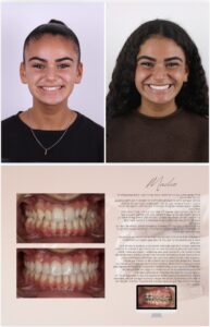 Before / After – Orthodontic Treatment - Dr Ruben Abou - myclinic Tel-Aviv