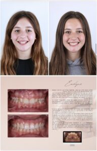 Before / After – Orthodontic Treatment - Dr Ruben Abou - myclinic Tel-Aviv