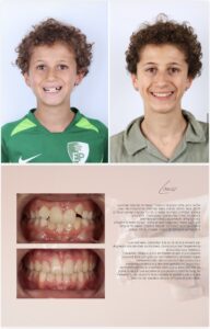 Before / After – Orthodontic Treatment - Dr Ruben Abou - myclinic Tel-Aviv