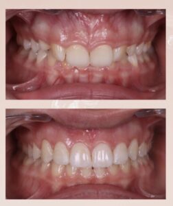 Before / After – Orthodontic Treatment - Dr Ruben Abou - myclinic Tel-Aviv