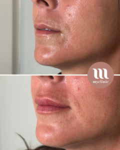 לפני / אחרי – הגדלת שפתיים בחומצה היאלורונית - myclinic - תל אביב