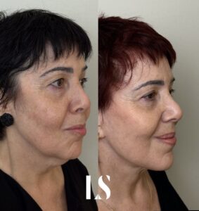 Before / After - Face &amp; Neck Lift - by Dr. Samuel Levy - myclinic Tel-Aviv