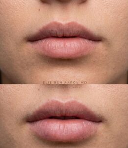 לפני / אחרי – הגדלת שפתיים בחומצה היאלורונית - myclinic - תל אביב