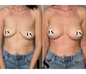 Before / After - Breast Augmentation - by Dr. Samuel Levy - myclinic Tel-Aviv