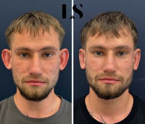Before / After - Otoplasty - by Dr. Samuel Levy - myclinic Tel-Aviv