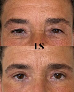 Before / After - Upper & Lower Blepharoplasty - by Dr Samuel Levy - myclinic Tel-Aviv
