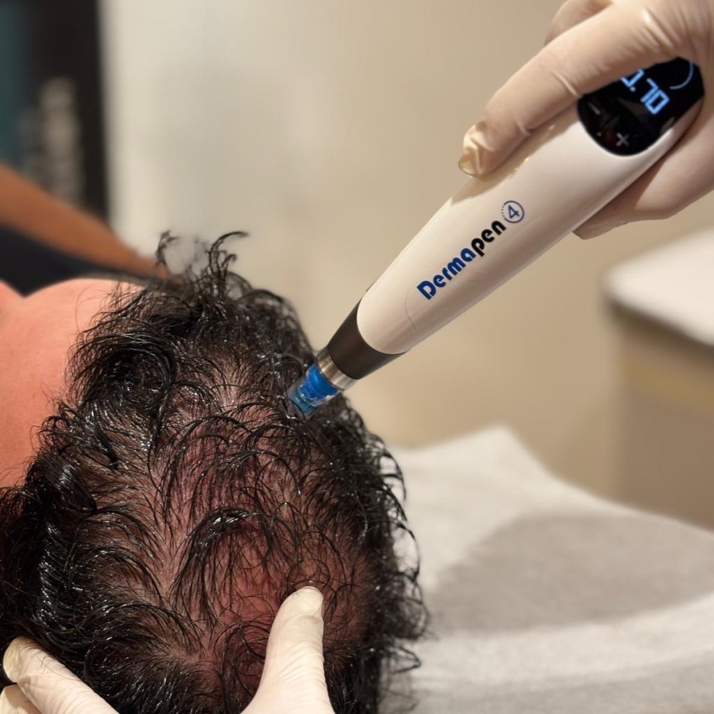 Dermapen + Exosomes Hair - myclinic Tel-Aviv