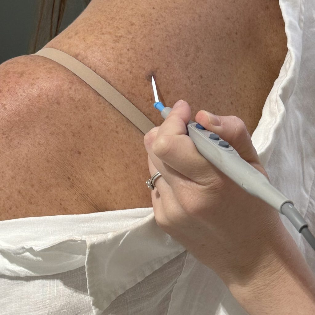 Diathermy myclinic Tel-Aviv