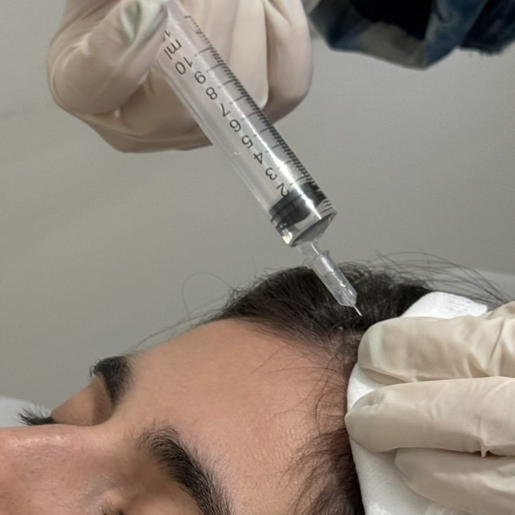 Mesotherapy – Doctor Carole Boukobza – myclinic Tel-Aviv Mesotherapy - Doctor Carole Boukobza - myclinic Tel-Aviv